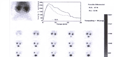 Cintilografia renal com DTPA_Tc99m