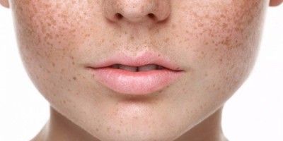 Melasma: 7 características que você precisa saber!