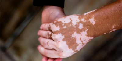 Como cuidar do vitiligo?