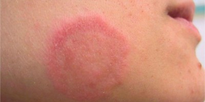 Micose: por que ela tende a aparecer no verão?