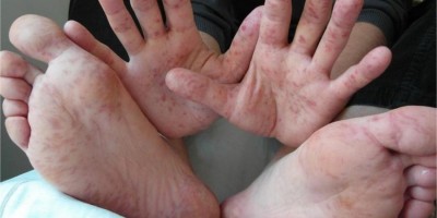 Síndrome mão-pé-boca: o que é? Como se transmite?