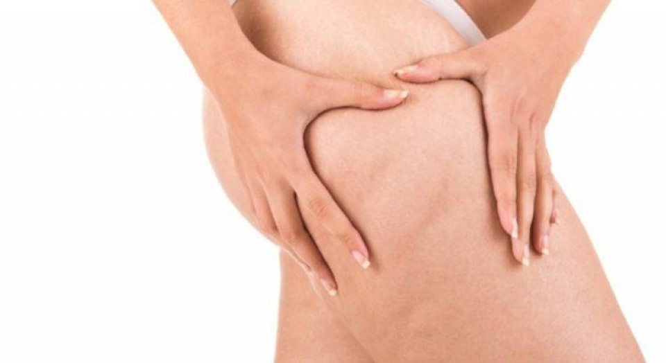Celulites: como preveni-las e eliminá-las?