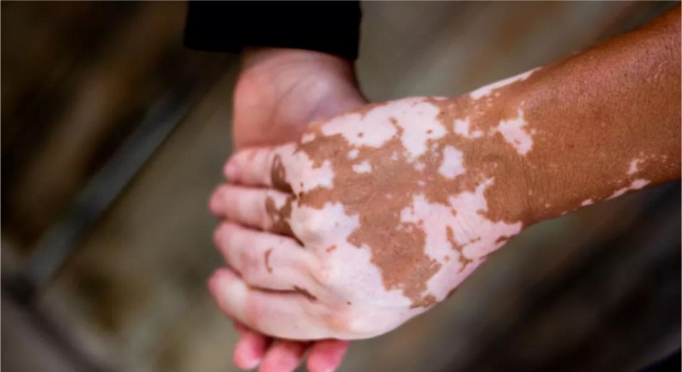 Como cuidar do vitiligo?