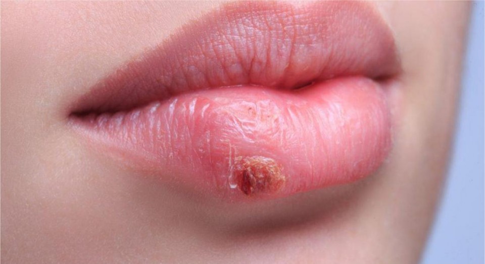 Sofre com herpes? Conheça alguns cuidados!