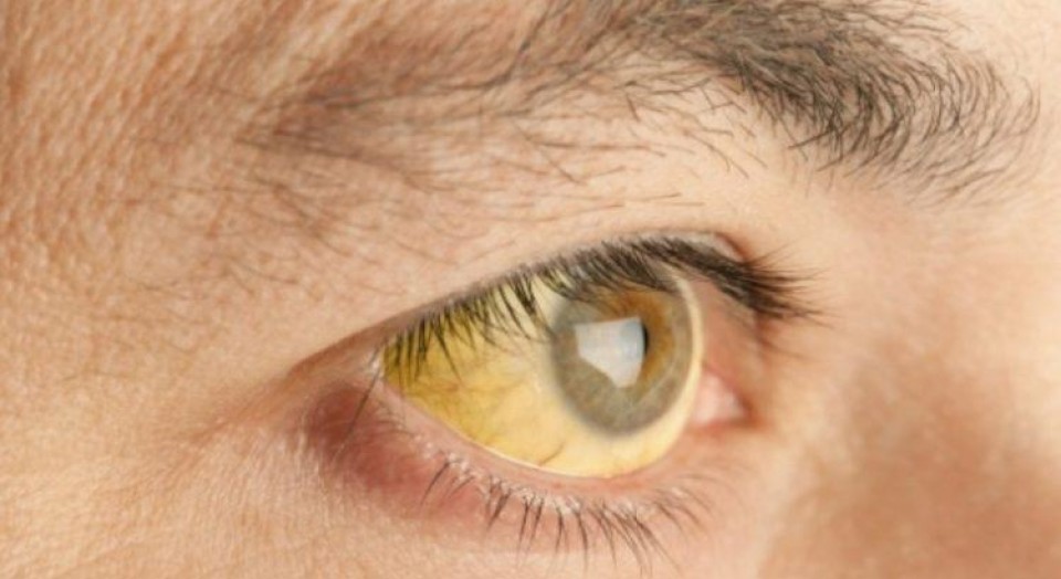 Febre amarela: o que é a doença? Quando devo tomar a vacina? Febre amarela: o que é a doença? Quando devo tomar a vacina?