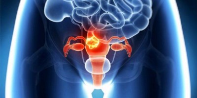 7 informações que toda mulher precisa saber sobre Câncer de colo de útero 7 informações que toda mulher precisa saber sobre Câncer de colo de útero