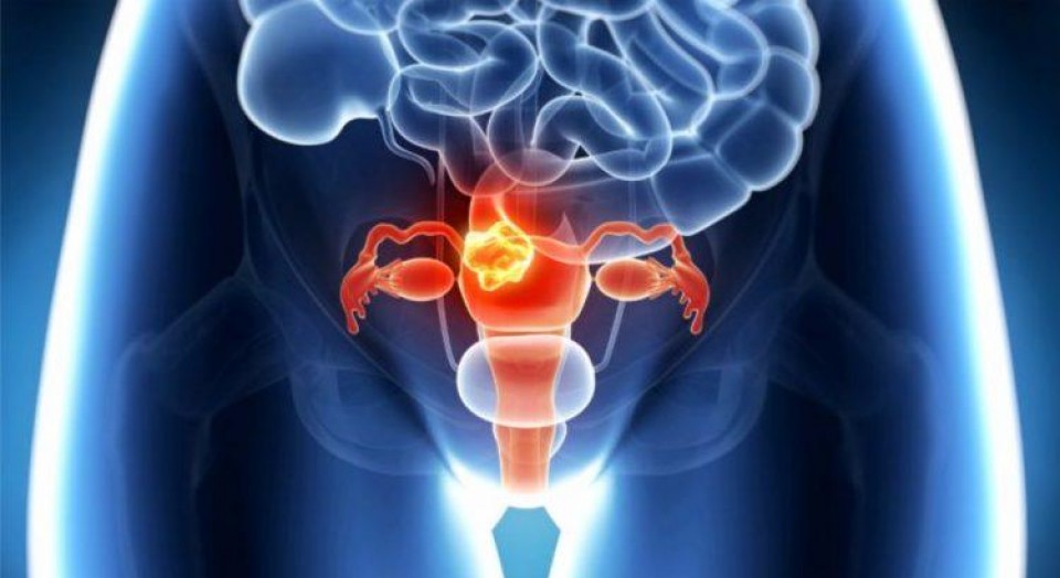 7 informações que toda mulher precisa saber sobre Câncer de colo de útero 7 informações que toda mulher precisa saber sobre Câncer de colo de útero