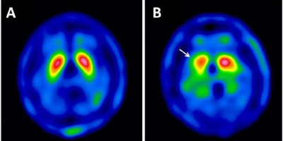 Mal de Parkinson: novo meio de diagnosticar esta doença já está no Piauí Mal de Parkinson: novo meio de diagnosticar esta doença já está no Piauí