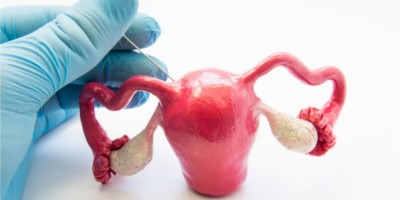 Síndrome dos ovários policísticos: talvez você tenha e não saiba! Síndrome dos ovários policísticos: talvez você tenha e não saiba!